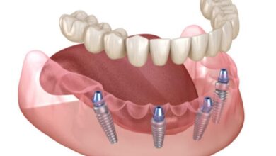 Dentist for Dentures and Implants