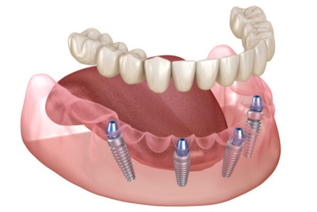 Dentist for Dentures and Implants