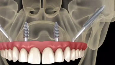 Dental Implants