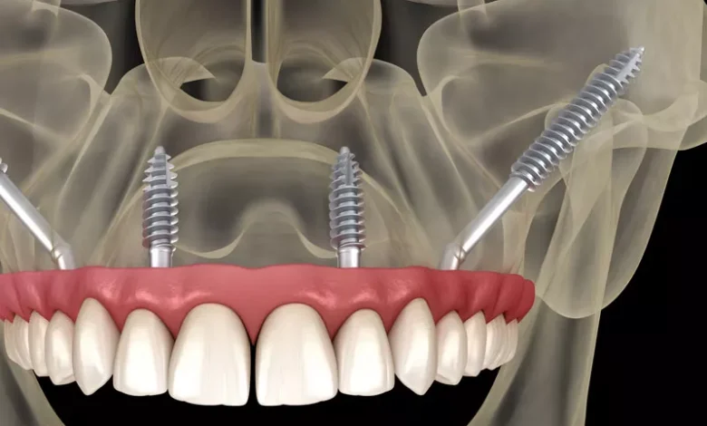 Dental Implants