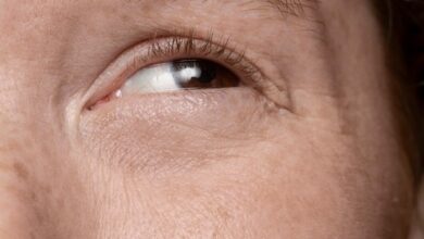 Blepharoplasty