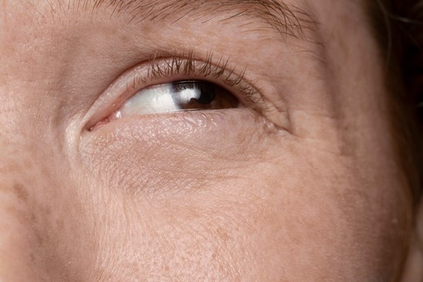 Blepharoplasty