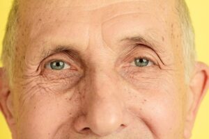 Blepharoplasty