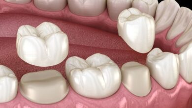 Dental Crowns 101