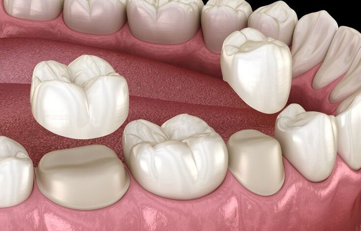 Dental Crowns 101