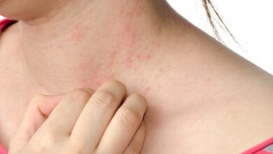 Eczema Treatment