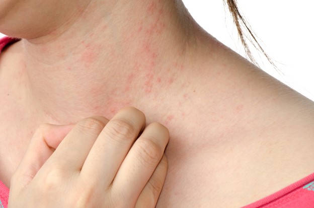 Eczema Treatment