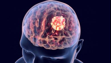 Glioblastoma