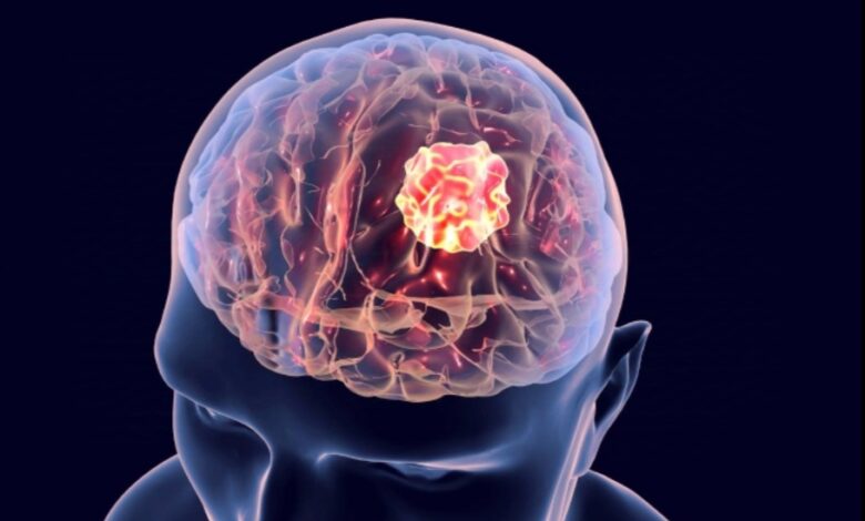 Glioblastoma