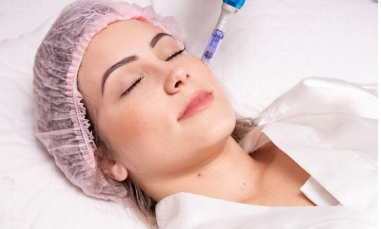 Microneedling