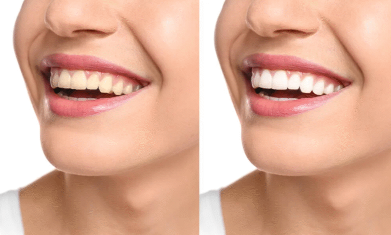 Crest 3D White Strips