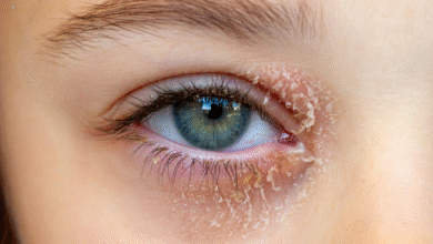 Eye Wipes for Blepharitis: A Gentle Option for Cleaner, Fresher Lids