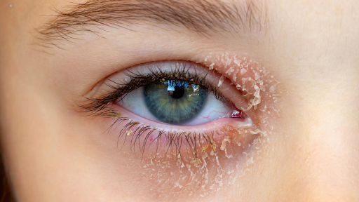 Eye Wipes for Blepharitis: A Gentle Option for Cleaner, Fresher Lids