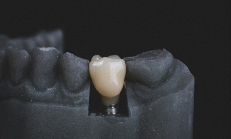 Dental implants