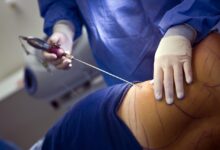 Liposuction