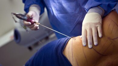 Liposuction
