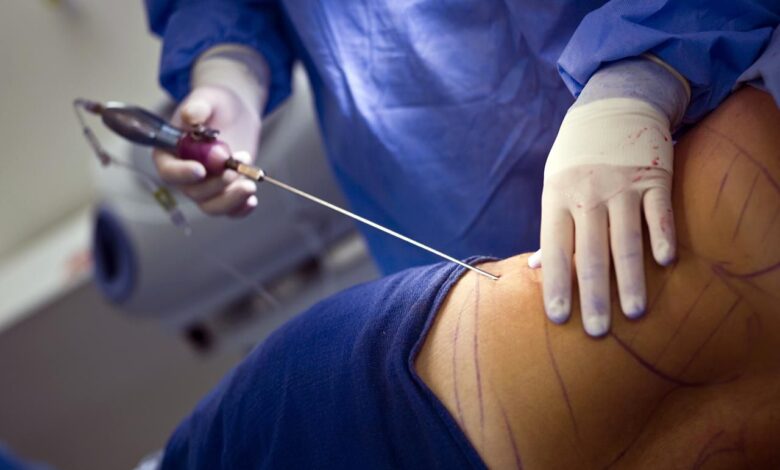 Liposuction