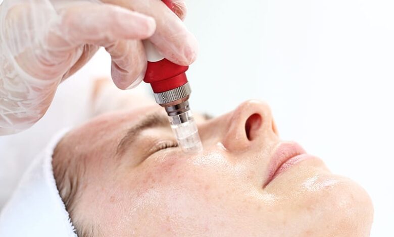 Microneedling